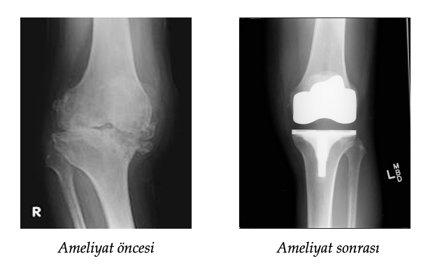 Total diz protezi ameliyatı öncesi ve sonrası